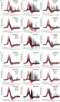 Spontaneous Recovery of the Vestibulo-Ocular Reflex After Vestibular Neuritis; Long-Term Monitoring With the Video Head Impulse Test in a Single Patient